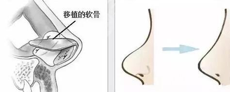 上海薇琳做鼻子手术果