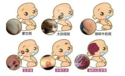 激光去胎记