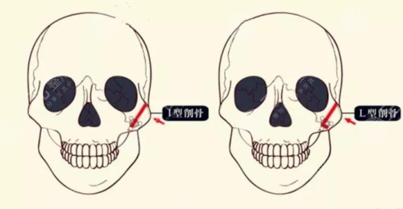 磨颧骨手术适合多大年纪的人