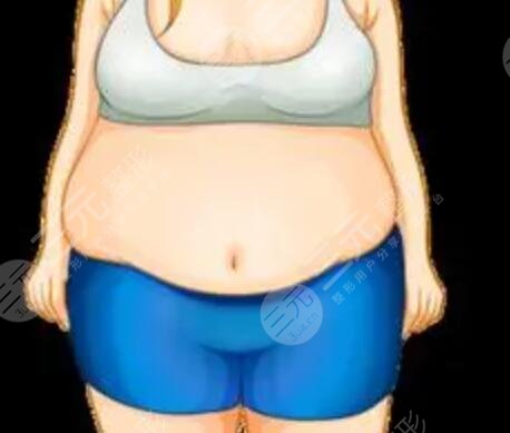 北京夏芙医疗美容机构吸脂瘦身后