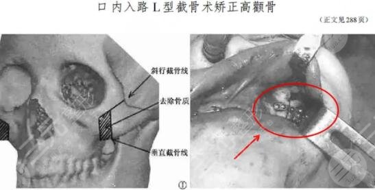 磨颧骨手术要休息多久