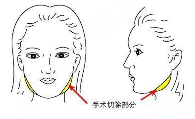 下颌角磨骨