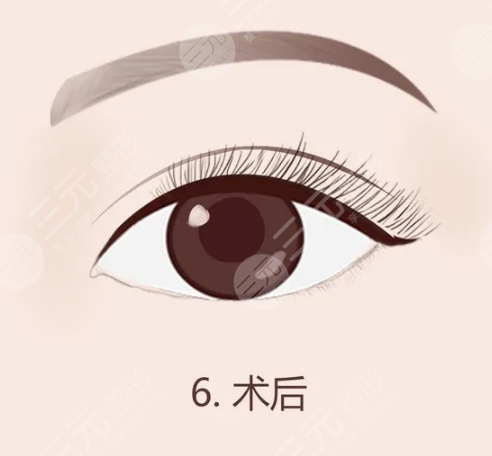 重睑术