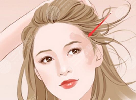 手术去胎记的步骤：