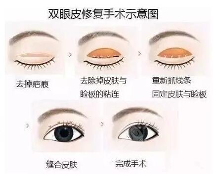 双眼皮失败修复有副作用吗?