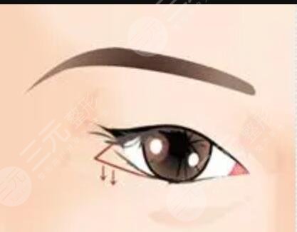宝鸡人民医院整形美容科割双眼皮,内附真实案例分享