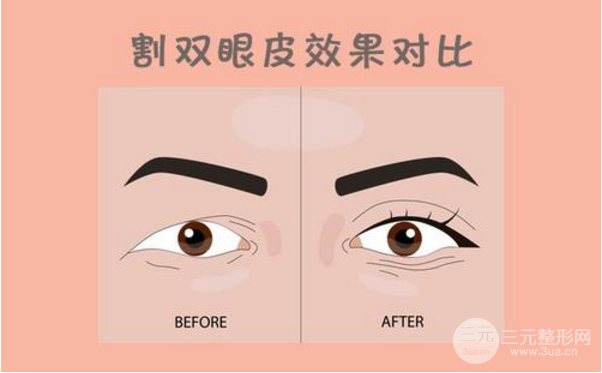 九院医生说双眼皮案例