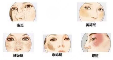 广州激光祛斑手术项目案例体验反馈: