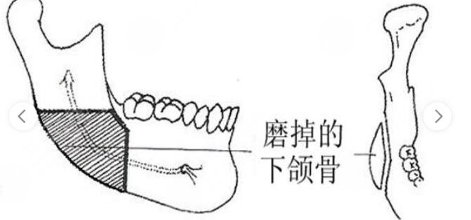 八大处磨骨失败案例有吗?