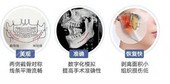 下颌角磨骨案例