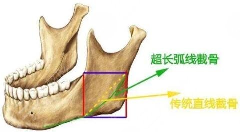 上海伊莱美做下颌角案例