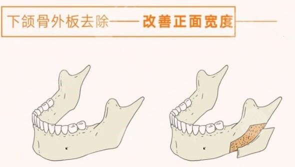 下颌角