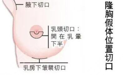 隆胸切口