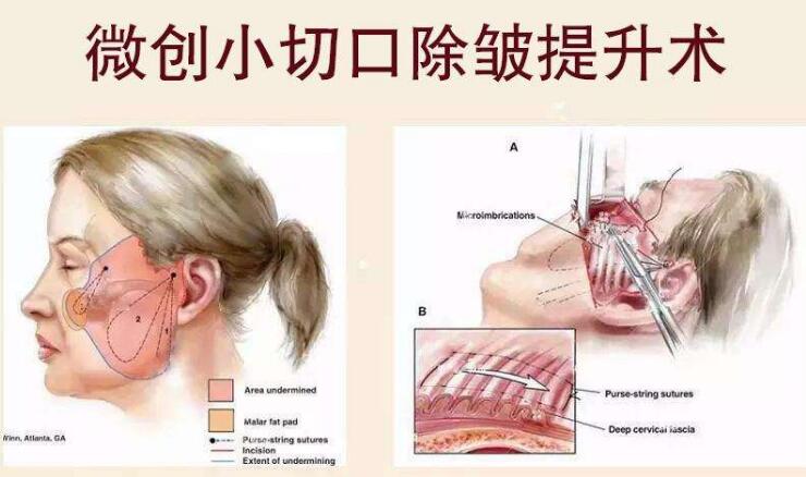 北京加减美医疗美容医院科普拉皮除皱