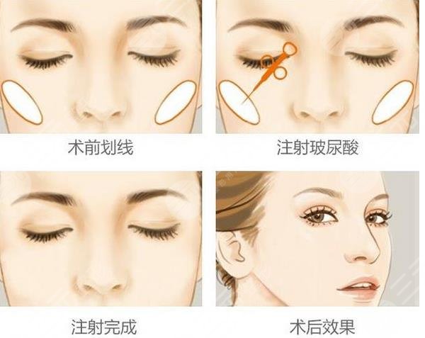 自体脂肪填充苹果肌后的注意事项