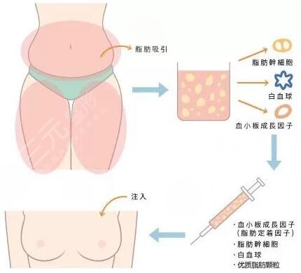 脂肪隆胸