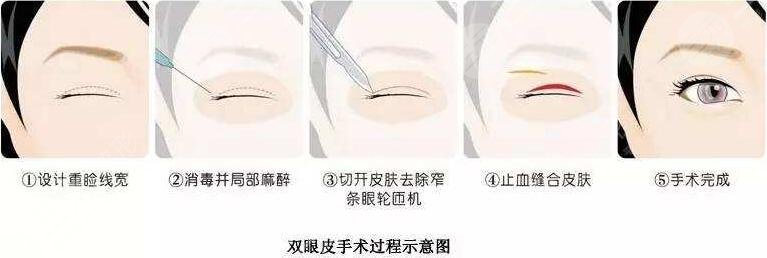 华人美容整容医院双眼皮照片