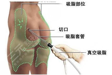 北京韩啸医疗美容腹部吸脂案例