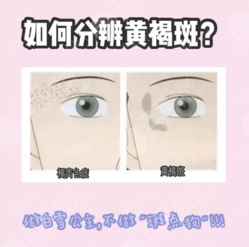 祛黄褐斑有什么好的方法