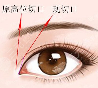 双眼皮整形手术