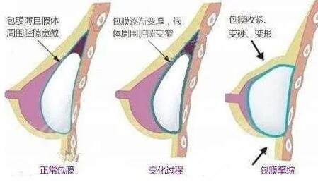 八大处隆胸案例分享