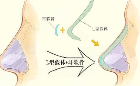 北京八大处全肋骨隆鼻项目案例体验反馈: