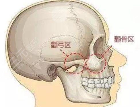 颧骨整形