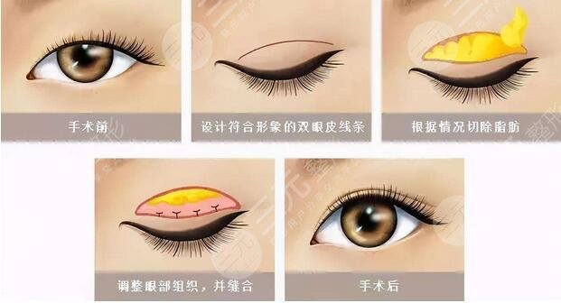 做双眼皮手术之后