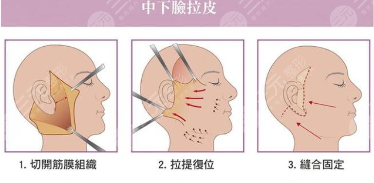 国内做拉皮手术案例