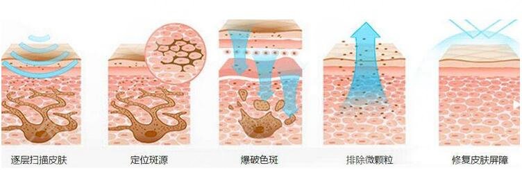 北滘医院袪斑果图反馈