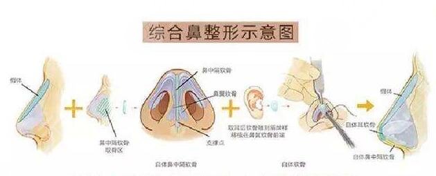 北京艺星鼻整形案例