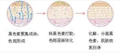 郑州激光祛斑案例果