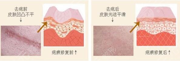 深圳去疤痕手术果反馈