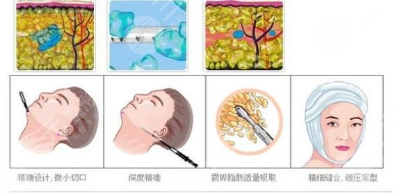 华西医院抽脂改脸型项目案例体验反馈：