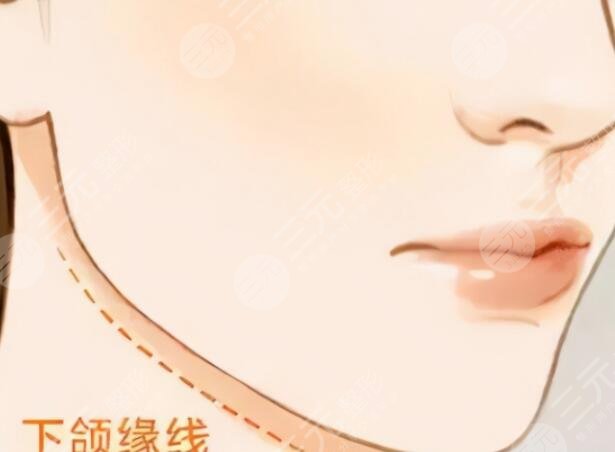 宽下颌角整形效果好吗？术前术后的注意事项都帮你整理好了，术前必看攻略~