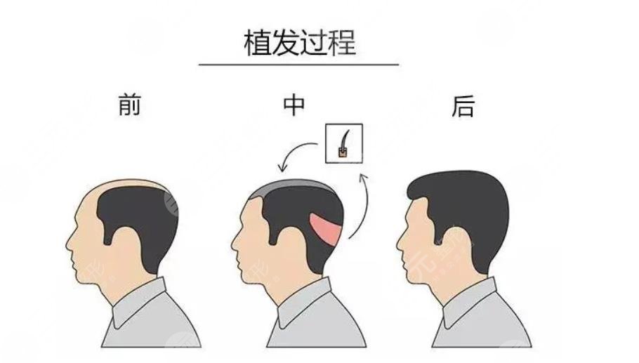 植发手术介