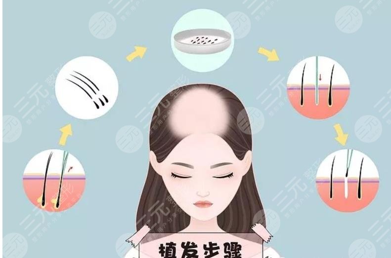 植发手术介