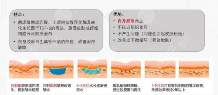 注射艾维岚用多大针头?和玻尿酸的区别是什么?轻医美知识在线解疑~