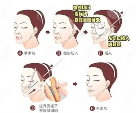 大拉皮手术多久效果好