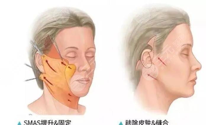 大拉皮手术多久效果好