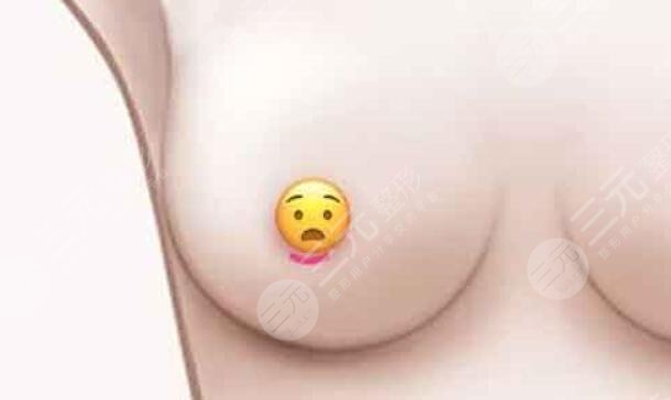 妙桃琴面假体隆胸优势