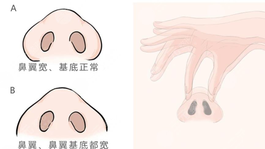 隆鼻术后的10大注意事项