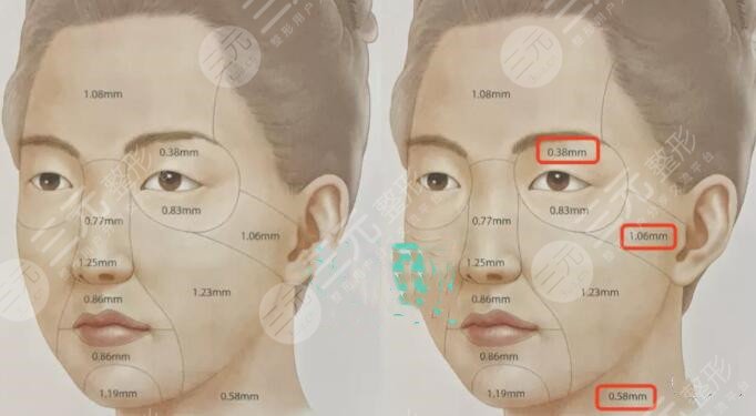 进行拉皮手术的注意事项