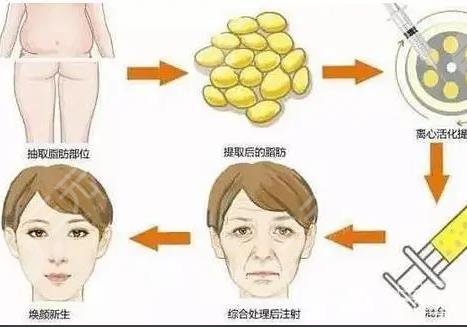 面部凹陷自体脂肪填充的价格是多少?