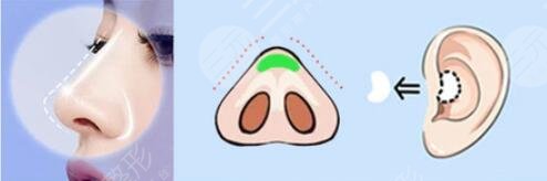 假体隆鼻效果的影响因素