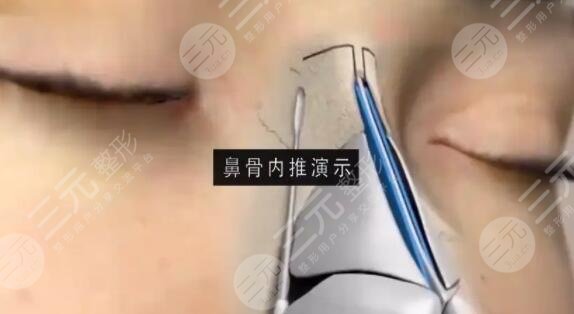 隆鼻硅胶假体分几种材质？型号与类型帮你逐一点评，这份变美攻略限时供应~