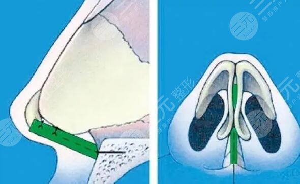 隆鼻硅胶假体分几种材质？