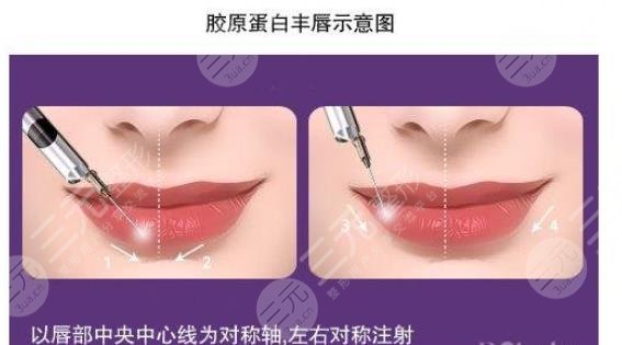唇形不好看怎么矫正?整形效果怎么样?注意事项+适合人群盘点!