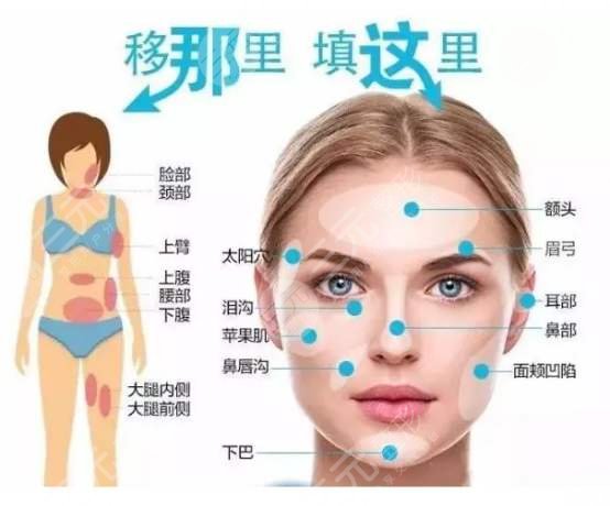 脂肪填充脸部介绍