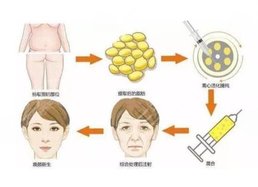 面部凹陷用什么填充好？假体、自体脂肪等都很受欢迎！